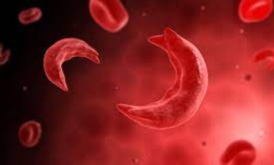 World Sickle Cell Day: MOH to Ease Burden on Patients