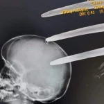 An x-ray image showing the fork jembe lodged in the boy's head.