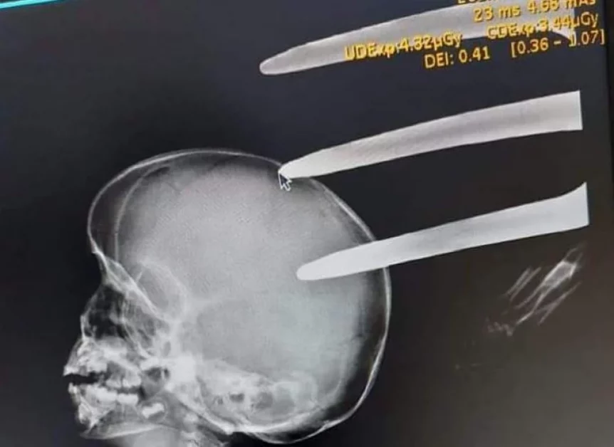 An x-ray image showing the fork jembe lodged in the boy's head.