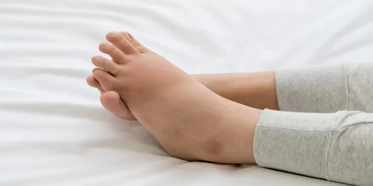 How to Get Rid of Swollen Feet During Pregnancy