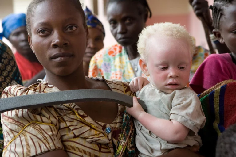 Ways We Can Celebrate People with Albinism