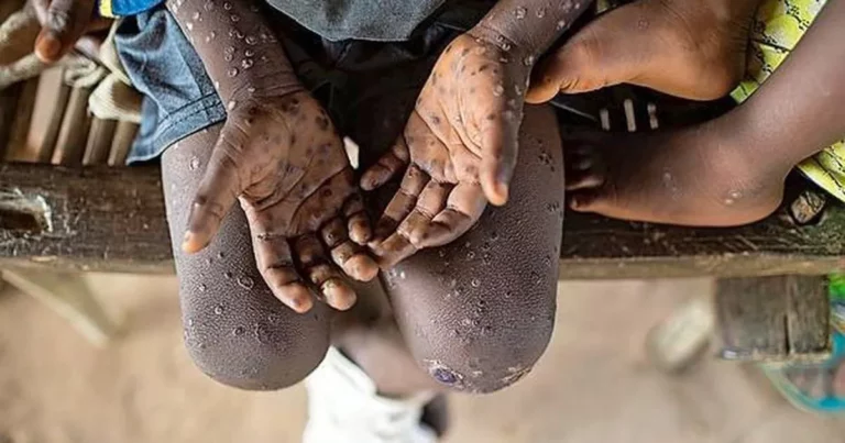 The Spread of Monkeypox in Kenya: What You Need to Know