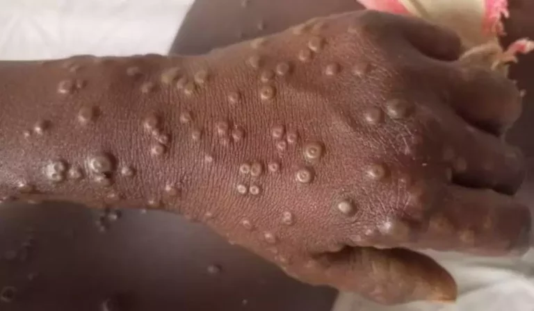 MoH Records 13 Cases of Mpox in Kenya, 1 Dies